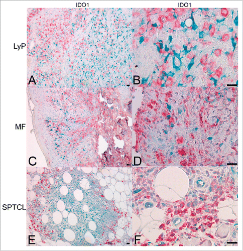 Figure 4. IDO1 is expressed in CD163+ TAMs in SPTCL but not in MF or LyP skin lesions. Double IHC staining for IDO1 (turquoise) and CD163 (red) showing (A and B) LyP lesions and (C and D) MF lesions with separate cells expressing either IDO1 or CD163 (10x, and 40x, respectively), (E and F) Double positive IDO1+/CD163+ TAMs are seen surrounding the periadipocytic SPTCL infiltrate like a protective wall (10x and 40x, respectively). Light hematoxylin counterstaining. (Scale bar 20 µm). TAM, tumor-associated macrophage.