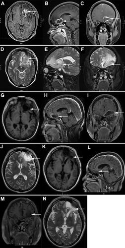 Figure 1 MRI images of the patient. (A–F) Preoperative MRI examination revealed slightly longer T1 and slightly longer T2 signals of the lesion (arrows). (A–C) T1-weighted images revealed a mass located in the left frontal lobe with a large cross section of 4.3×3.2 cm. (D–F) T2-weighted images reveals an enormous edema area around the lesion. (G–J) Postoperative MRI examination revealed a residual cavity was formed in the left frontal lobe, a small amount of fluid was accumulated in the left frontal subdural (G, arrow), a long shadow of T1 and long T2 signals was observed in the left frontal lobe (H and I, arrows), the edge was enhanced by enhanced scanning (J, arrow). (K–N) The MRI images after 8 months revealed the residual cavity in the left frontal lobe was smaller than before (arrows).