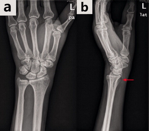 Figure 6. The same wrist with a DRF in the anterior–posterior view radiograph (a) and in the lateral view radiograph (b). The hidden DRF in the anterior–posterior view was apparent in the lateral view (the fracture is shown by the red arrow).