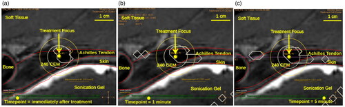 Figure 4. T2-weighted MRI image of Achilles tendon with area Outlining 240 cumulative equivalent min at 43 °C (240CEM) at three time points: (a) immediately after treatment, (b) 1 min after treatment, and (c) 5 min after treatment.