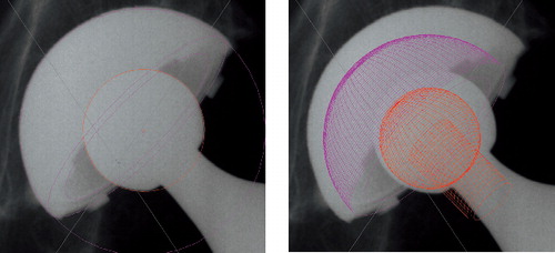 Figure 27.  Graphic output of wear analysis using PolyWare Pro 3D Digital. To the left digital edge-detection by fitting circles to the borders of the cup and head is shown, and to the right a solid model is applied at the end of analysis.