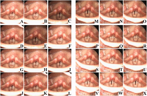 Figure 2. Stroboscopic vocal fold examination of a representative patient with chorditis. The patient, a 20s woman, presented with severe dysphonia. Stroboscopy at the first visit showed chorditis (A–L); the free edges of the vocal folds were erythematous and swollen, and there was glottic insufficiency and decreased vibration. VFSI was performed for the bilateral vocal folds. Three months after VFSI, the patient’s voice significantly improved. Stroboscopy showed reduced vocal-fold swelling and glottic insufficiency and improved vocal-fold vibration (M–X).