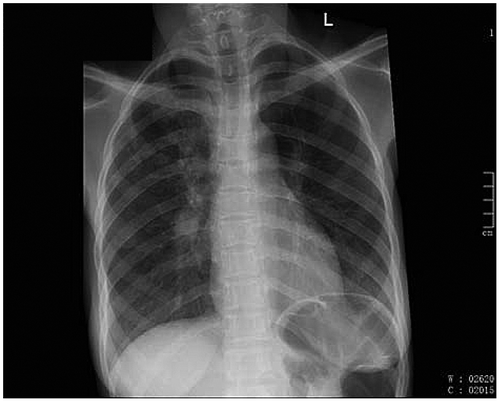 Figure 7: Chest X-ray 30 months after treatment (April 2008), showing hilar infiltrates.