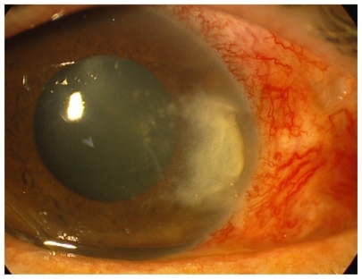 Figure 1 Abscess of the nasal cornea of the right eye. The abscess, measuring 6 mm high and 4 mm wide, was located on the pterygium ablation site. Ulceration with raised edges of about 3 mm was in the center of the abscess. The abscess was surrounded by infiltrate with irregular and ramified edges, as well as several microabscesses.