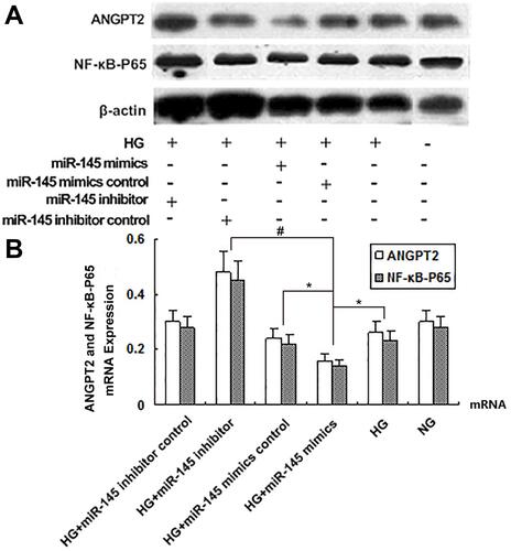 Figure 6 ANGPT2 and NFκB p65 protein and mRNA levels of RAECs determined by Western blot and RT-PCR under hyperglycemia at 25 mmol/L. (A) Protein levels on Western blot. (B) Quantitative analysis of protein levels. β-actin was used as an internal control in both assays. *P<0.05 for HG+miR145 mimics vs HG or HG+miR145 NC mimics; #P<0.01 for HG+miR145 mimics vs HG+miR145 inhibitor (n=4 each).