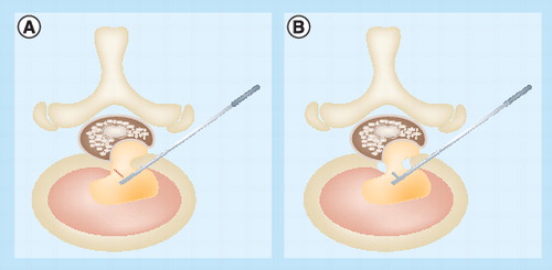 Figure 3. Schematic drawings demonstrating the importance of annular release and complete herniotomy.The herniated fragment should be separated from the tight annular anchorage and freed before removal. The releasing procedure can be performed using a side-firing laser and annulus cutter (A). Then, complete removal of the whole hernia fragment in both the epidural and the intradiscal space should be performed to prevent recurrence (B).