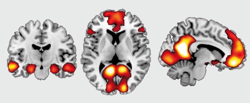 Figure 1. Regions of a core network engaged by imagining future events. In a recent study described in the text,Citation87 participants imagined future events including person, place, and object details that were taken from actual memories. On control trials, participants created a “size sentence,” ordering three objects by physical size. The contrast of future events relative to control trials revealed significant activation of a core network identified in other similar studies, including bilateral medial parietal and prefrontal cortices (right and middle) and bilateral medial temporal lobes and left lateral temporal cortex (left). Adapted from ref 87: Martin VC, Schacter DL, Corballis MC, Addis DR. A role for the hippocampus in encoding simulations of future events. Proc Natl Acad Sci U S A. 2011;108:13858-13863. Copyright© National Academy of Sciences 2011.