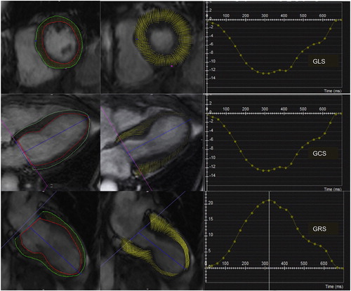 Figure 1. CMR-feature tracking in Takotsubo Cardiomyopathy: Global Longitudinal Strain (GLS) and Global Circumferential Strain (GCS) and Global Radial Strain (GRS), are calculated from the short axis, four-chamber and two-chamber SSFP cine images (cvi42, Circle Cardiovascular Imaging).