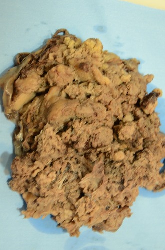 Figure 1 Gross features of placenta show multiple well defined rubbery nodules located on the chorionic plate.