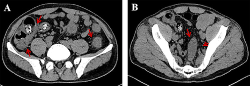 Figure 2 Abdominal CT scan findings. Image showing diffuse thickening of the colonic wall of ascending and descending colon (A) and sigmoid colon (B) (arrows), likely secondary to inflammation.