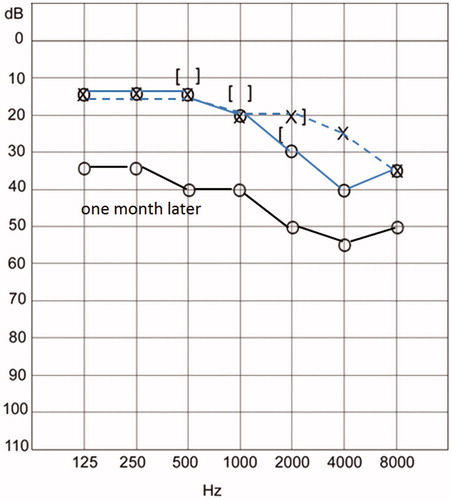 Figure 1. Pure-tone audiogram. His right hearing loss was progressed in one month. O: right air-conducted hearing level; X: left air-conducted hearing level; [: right bone-conducted hearing level; ]: left bone conducted hearing level.