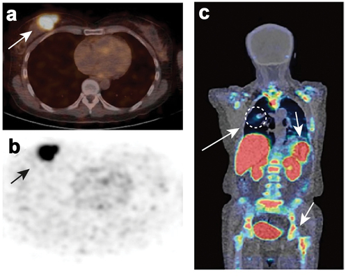 Figure 3. PET/CT imaging of cancer and immune cells using Nb-based diagnostics. A-B) example of noninvasive imaging of a HER2+ breast carcinoma tumor using 68Ga-NOTA-Anti-HER2 VHH1. HER2-expression could be visualized with 68Ga-NOTA-Anti-HER2 VHH1 in a primary breast carcinoma lesion (arrow) on PET/CT images (a) and PET images (b). This image was originally published in J Nucl Med: M. Keyaerts, C. Xavier, J. Heemskerk et al. Phase I study of 68Ga-HER2-nanobody for PET/CT assessment of HER2 expression in breast carcinoma. J Nucl Med. 2016;57(1):27–33. © SNMMI. c) Example of noninvasive PET/CT imaging of CD8+ T-cells in a lung cancer patient 60 mins post injection of 68Ga-NODAGA-SNA006. CD8+ T-cells could be visualized in the lung tumor (circle and arrow) and immune-rich organs, including bone marrow and spleen (arrows). This image was originally published as Wang, Y. et al. Pilot study of a novel nanobody 68Ga-NODAGA-SNA006 for instant PET imaging of CD8+ T-cells. Eur J Nucl Med Mol imaging 49, 4394–4405 (2022).