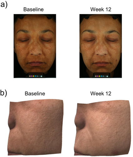 Figure 3 Improvements observed in hyperpigmented skin after 12 weeks of DGR. Participant pictured was a 49-year-old woman with Fitzpatrick Skin Type IV. (a) Photographs under cross-polarized lighting showing improvements in the appearance of dark spots and skin tone unevenness. (b) 3D images showing marked improvements in skin texture and overall discoloration.