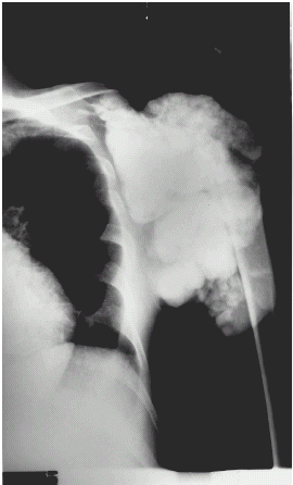 Figure 1. X-ray showing extensive periarticular calcification involving left shoulder and soft tissues around it.