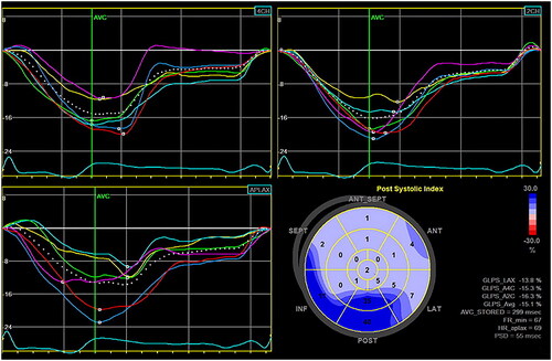 Figure 2. Screenshot from EchoPac 202x AFI software. Strain curves from apical 4-chamber (4CH), apical 2-chamber (2CH) and apical long axis (APLAX). The peak strain over the whole beat is marked with a white square on the curves. The bulls-eye plot shows the post-systolic index (PSI) in different segments. In basal and mid posterior segments, the PSI is 40 and 35 accordingly, this corresponds to the yellow and cyan curve in the APLAX-view.