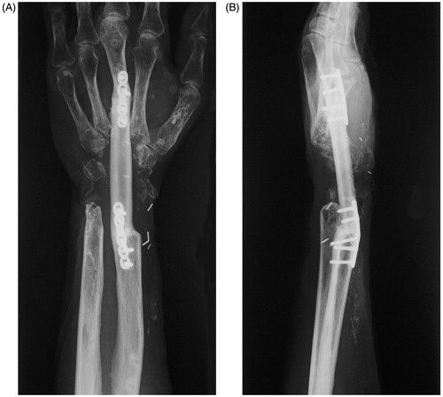 Figure 4. Radiographs 33 months after surgery showing complete union of both sides of the fibula: (A) posteroanterior view; (B) lateral view.