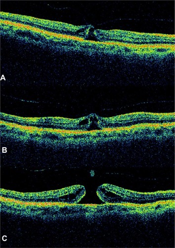 Figure 7 Sequential foveal tomographic images by time-domain optical coherence tomography.