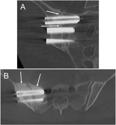 Figure 6 Sample radiographic outcomes. (A) Coronal CT image at 5 years of the right sacroiliac joint showing >30% bony apposition around all 3 implants and bridging bone adjacent to both the superior and middle implants (white arrows). (B) Axial CT image at 5 years of the right sacroiliac joint demonstrating positive bony remodeling (increased bone density) around the right-sided implants on both the sacral and iliac sides (white arrows).