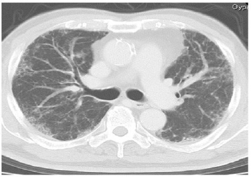 Figure 1 Chest computed tomography scan obtained 5 months before presentation.
