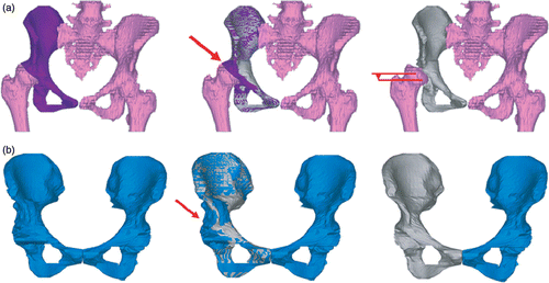Figure 4. Automated correction proposals for the innominate bone: (a) planning and/or diagnosis of hip dysplasia; (b) tumor reconstructive surgery. For each case (from left to right), the original, original and correction, and correction proposal are presented. An arrow indicates the location of the defect/deformity in the original bone mesh; in (a), a pair of horizontal lines indicates the required vertical displacement of the patient's femur. [Color version available online.]