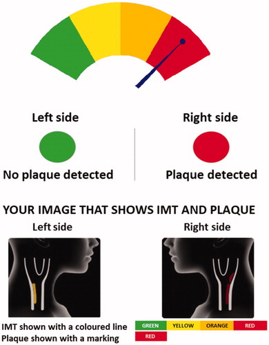 Figure 1. Pictorial information based on ultrasound examination of the carotid arteries presented to GPs and their patients.