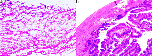 Figure 2 (a) FS showed areas of mature cystic teratoma; (b) borderline mucinous cystadenoma combined with mature cystic teratoma were noted on PS.