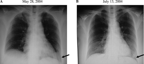 Figure 1.  The change in the tumor size in the chest x-ray photograph before (A) and after (B) the therapy was observed. After the therapy, size of the tumor in the left lower lobe decreased significantly.