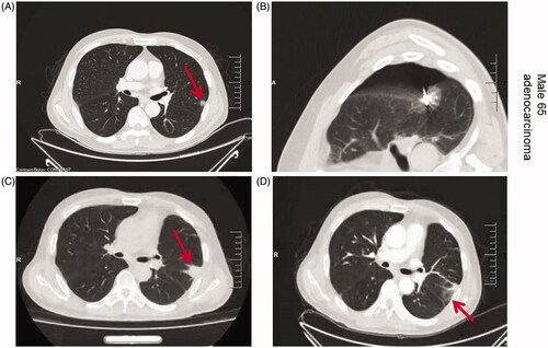 Figure 1. Axial CT images of the 65-year-old men with lung cancer treated with RFA. Upper left: CT prior to RFA treatment shows peripheral carcinomas in the left lung (arrow); Upper right: CT findings during RFA treatment, the ablation site is covered with ground glass; Lower left: CT image 3 months after RFA treatment shows increased appearance and decreased density of the treated area; Lower right: CT image 6 months after RFA treatment shows ground-glass changes in the treated area, cavitation changes in the primary focus, and surrounding fibrotic scarring with signs of inflammation.
