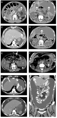 Figure 1 Cross-sectional abdominal CT images of EPS Type I–III patients.