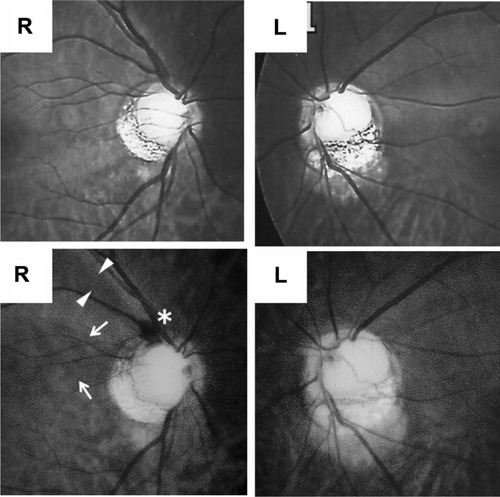 Figure 2 Red-free fundus photographs of the patient taken in 2002 (top) and 2007 (bottom).