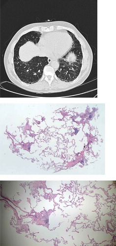 Figure 1. 71-year-old male referred for dyspnea. HRCT showing reticulation, ground glass opacity and traction bronchiectasies with basal predominance. Cryobiopsies showing patchy fibrosis, fibroblastic foci and chronic inflammation. The patient was diagnosed with idiopathic pulmonary fibrosis, high confidence