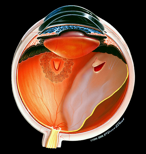 Figure 1 Illustration of retinal detachment from a new tear in normal appearing retina in an eye that had previously received focal laser for a retinal tear elsewhere. Image ©(2005)Stephen F. Gordon.