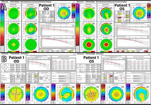 Figure 2 (A) Pentacam enhanced ectasia display maps demonstrating significant central thinning OU. (B) Pentacam refractive maps.