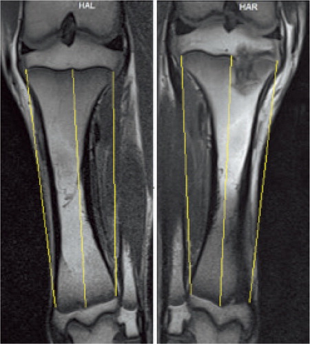 Figure 1. High-resolution T1 MR images 12 weeks after the procedure. The distance between the 2 tibial physes (proximal and distal) was measured laterally, centrally, and medially (yellow lines) to compare tibial length in the control leg (left) and in the treated leg (right). Both lateral and medial sites were ablated in the treated tibia, but it is difficult to visualize both in the same MR slice.