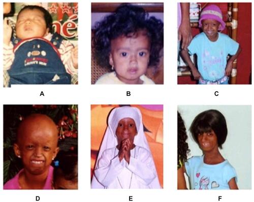 Figure 2 Patient at one month-of-age (A), six months-of-age (B), five years-of-age (C), six years-of-age (D), seven years-of-age (E), and thirteen years-of-age (F).