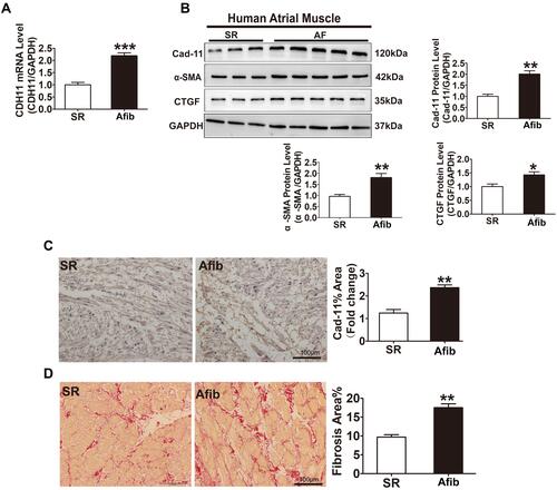 Figure 1 Increased CDH11 expression and fibrosis in the LA appendage tissues of patients with atrial fibrillation. LA tissues were obtained from patients with sinus rhythm (SR) or chronic atrial fibrillation (AFib). (A) CDH11 transcripts in the LA tissues of patients with SR or AFib were measured by quantitative RT-PCR. (B) Representative Western blotting images showing protein levels of CDH11, α-SMA, CTGF from patient atrial muscle tissues as indicated. GAPDH was used as internal control for protein normalization. Quantification of the band intensity for each protein was summarized in bar graphs. (C) Representative images of immunohistochemical staining of LA tissues from patient with SR or AFib as indicated. CDH11 levels were quantified and summarized in the bar graph on the left. Bar=100 μm. (D) Representative images of picrosirius red staining of the left atrial tissue for collagen (red staining) from patients with SR or AFib. Bar graph on the left summarized the area of fibrosis. Bar=100 μm. N=6. Data are presented as mean ± SD. *: p<0.05, **: p<0.01, ***: p<0.001 vs SR.