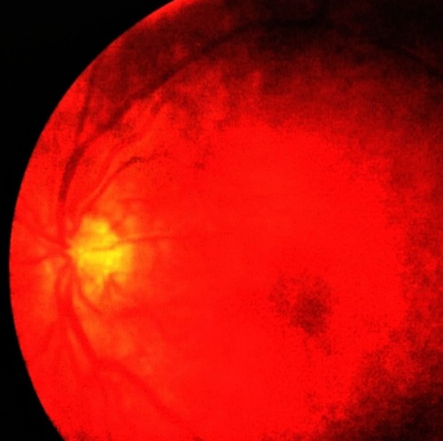 Figure 2 Fundus image showing spontaneous PSCRAP regression 8 months after diagnosis, leaving normal-appearing retina.
