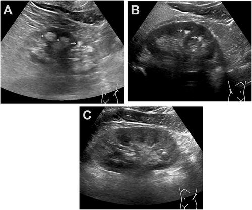 Figure 2 Ultrasound examination of the kidney in a patient with gout. (A) The largest coronal surface of the kidney in the patient’s lateral position shows that the right renal medulla of the patient with gout has increased echo (indicated by the yellow arrow). (B) The largest coronal view of the kidney from a patient in lateral decubulation, showing a pyramidal stone in a patient with gout (indicated by the yellow arrow). (C) Maximum coronal view of ultrasonography kidney image of a normal patient in lateral decubitus position.