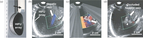 Figure 3. (a) HIFU annular array, integrated with an ultrasound imaging probe (arrow). (b) Before HIFU, patent hepatic vein (outlined by dashed lines) is visualized using Color Doppler (arrow). (c) During HIFU, hyperecho (arrow) formed at the position of the vessel. (d) After HIFU, the occluded vein (outlined by dashed lines) shows no flow (arrow). The site of treatment is seen as a hyperechoic region surrounding a vein that appears to be collapsed (arrowhead).