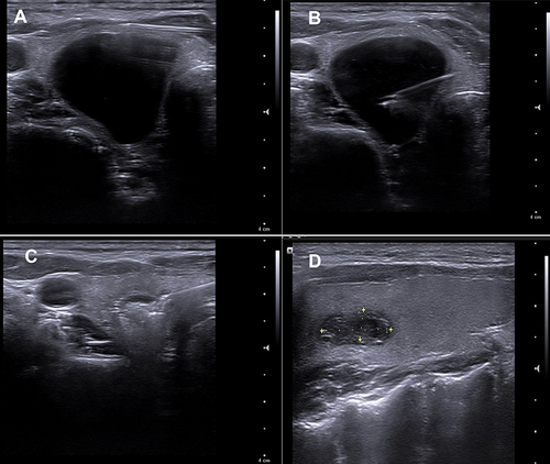 Figure 1 40-year-old woman who complained of right thyroid mass, pain, underwent ethanol ablation. (A) Axial sonographic view local anesthesia with 2% lidocaine at the needle-puncture site and peri-thyroidal area. (B) Axial sonographic view shows the 18 gauge needle was located in central region of cystic portion via trans-isthmic approach and cystic contents had been almost completely removed. (C) Axial sonographic view shows injection of ethanol into cystic thyroid nodule. (D) Cystic thyroid nodule reduces the volume after 1 month follow up.