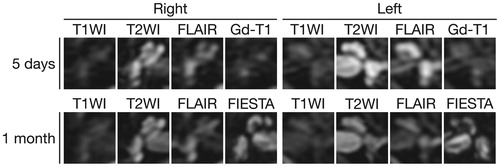 Figure 1. MRI of the temporal bones. Five days after the onset of hearing loss, axial T2-weighted images show high signal intensity from the fluid in both ears. Noncontrast fluid-attenuated inversion recovery (FLAIR) images show markedly high signal intensity in the whole cochlea and vestibule in the left ear and slightly high signal intensity in the right ear. Gadolinium-enhanced T1-weighted (Gd-T1) images show no abnormal enhancement. One month after the onset of hearing loss, the signal intensity on noncontrast FLAIR was decayed compared to that in the early phase of hearing loss. High signal intensity on T2-weighted image and three-dimensional fast imaging employing steady-state acquisition (FIESTA) images indicate the presence of fluid in both cochleae.