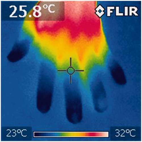 Figure 1. Thermography image of the hand of an SSc patient. Patients with SSc have poor peripheral blood flow and have a constantly low hand temperature. In this picture, the skin temperature is under 26 °C in the area where the cross cursor is pointed.
