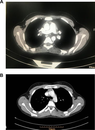 Figure 1 Mediastinal lymphadenopathy in a child with Kawasaki disease: (A) at presentation; (B) eight weeks later.
