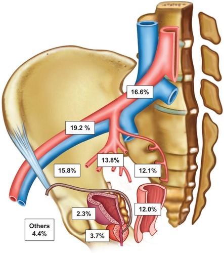 Figure 4 Anatomical distribution and localization of 890 sentinel lymph nodes of the prostate of 50 patients with intermediate- or high-risk prostate cancer based on MRI after intraprostatic SPION injection.Abbreviation: SPION, superparamagnetic iron oxide nanoparticles.