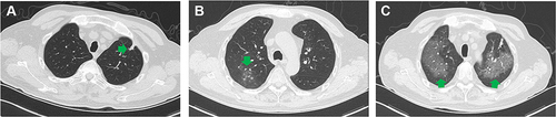Figure 1 Pulmonary imaging manifestations of the patient. (A) Irregular nodules in the left upper lung. (B) Ground glass opacities and small nodules in the upper lobe of the right lung. (C) Diffuse ground glass opacities in both lungs. Lesions mentioned above were pointed by the green arrows.