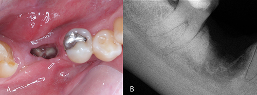 Figure 3 Clinical diagnosis of osteonecrosis with evidence of bone exposure (A) and periapical radiograph showing extensive bone loss (B).
