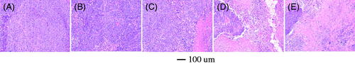 Figure 6. H&E-stained tumor tissues harvested from mice with different treatments. (A) Saline; (B) INEI; (C) taxol; (D) paclitaxel-loaded INEI (30% NBCA); and (E) paclitaxel-loaded INEI (40% NBCA).