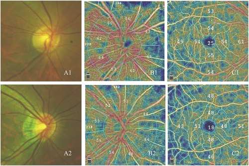 Figure 6. Effect of ONH morphology on the retina microcirculation; A) illustration of the fundus; B) OCTA picture of the IVD and PVD; C) OCTA picture of the MVD; A1, B1 and C1 illustrate pictures of the non-tilted disc group; A2, B2 and C2 pictures of the tilted disc group.