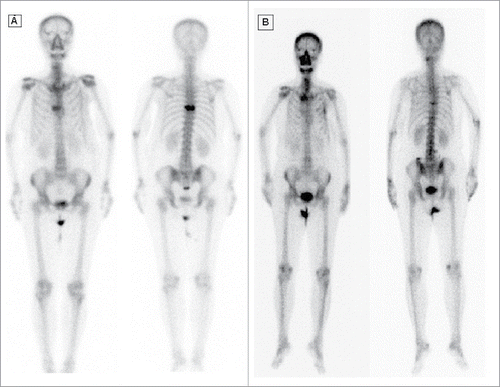 Figure 2. (A) Bone scan before palliative radiation. (B) Bone scan after 2 years, a resolution of bone lesion.