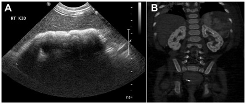 Figure 2 Radiological findings in patient 2.